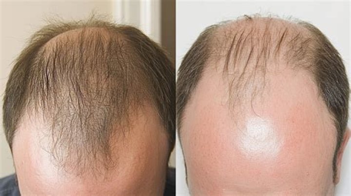 Can you stop or reverse balding?