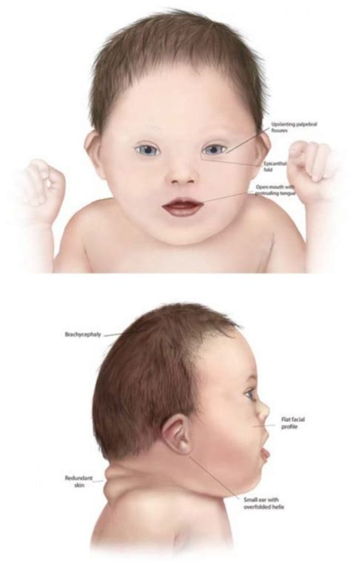Do babies with Down syndrome have seizures?