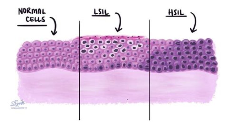 Does LSIL have symptoms?