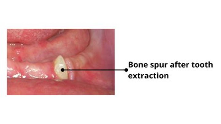 How are bone spurs in the gums treated?