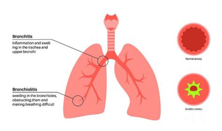 How can you tell the difference between bronchitis and bronchiectasis?