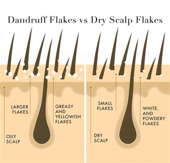 How do I get rid of dry flakes on my scalp?