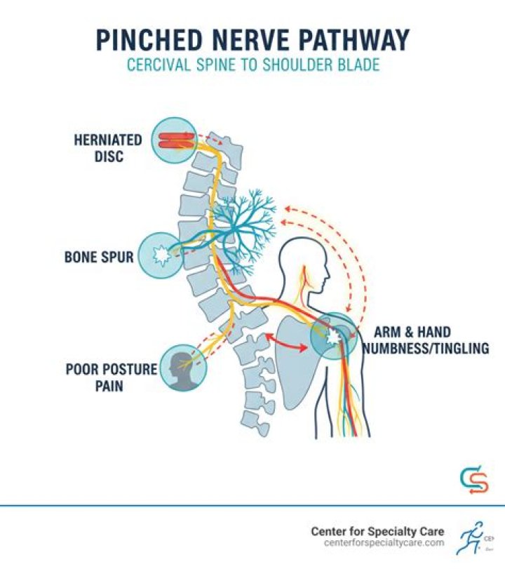 How do you get rid of a pinched nerve in your shoulder blade?