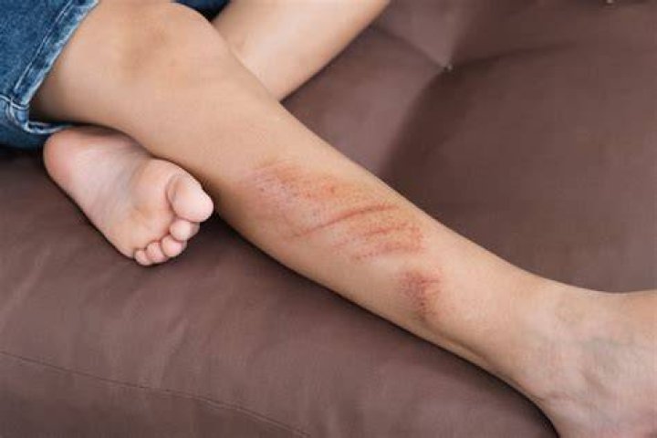 How do you make a fake abrasion?