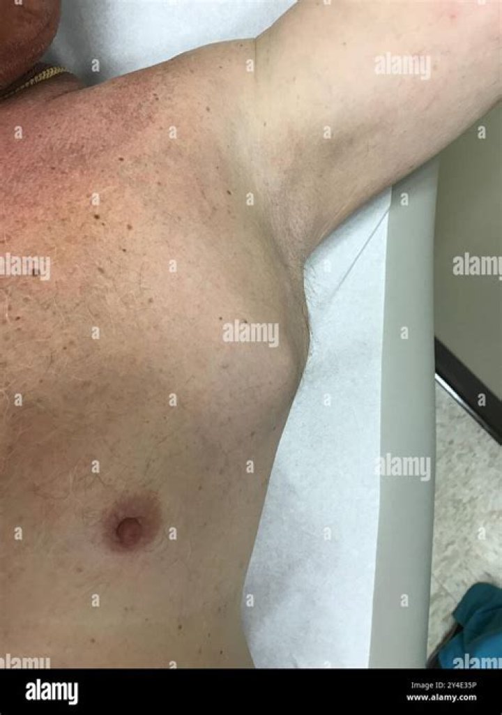 How do you treat an infected armpit sweat gland?