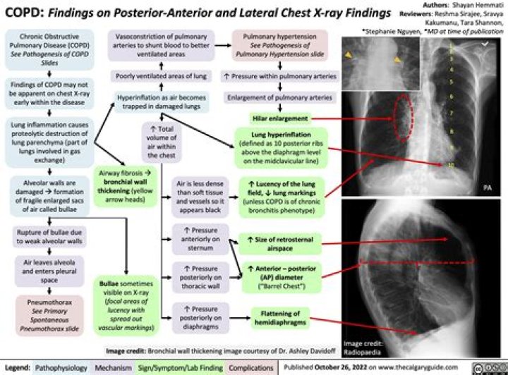 How does COPD appear on an X-ray?