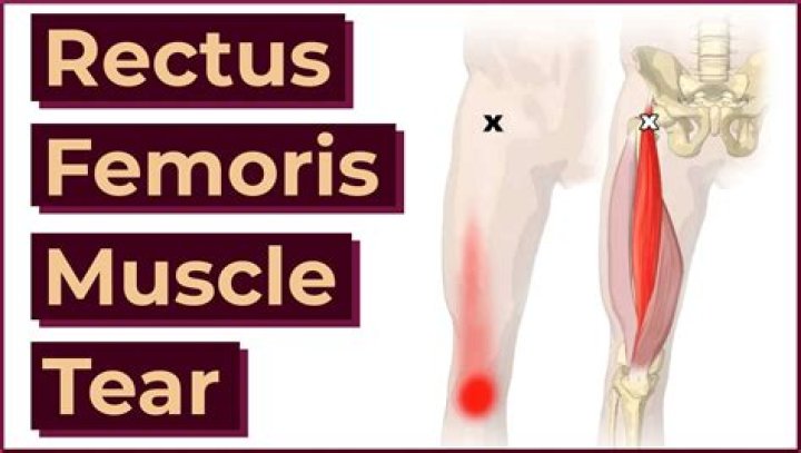 How is rectus femoris treated?