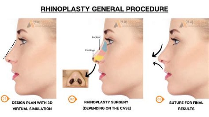 How is rhinoplasty surgery performed?