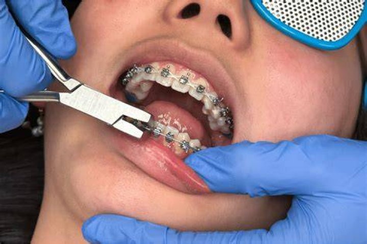 Is it never too late to get braces?