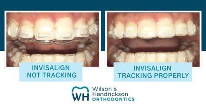 Is it normal for your Invisalign to be loose?