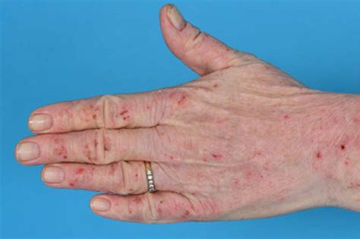 What does dermatitis look like on fingers?