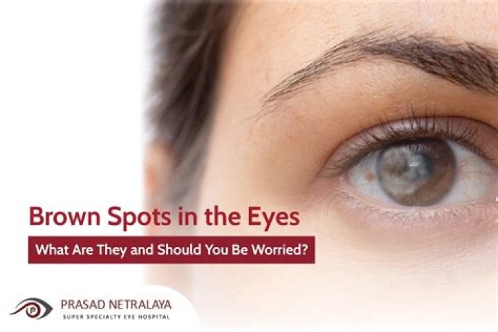 What does it mean when you have brown spots in your eyes?