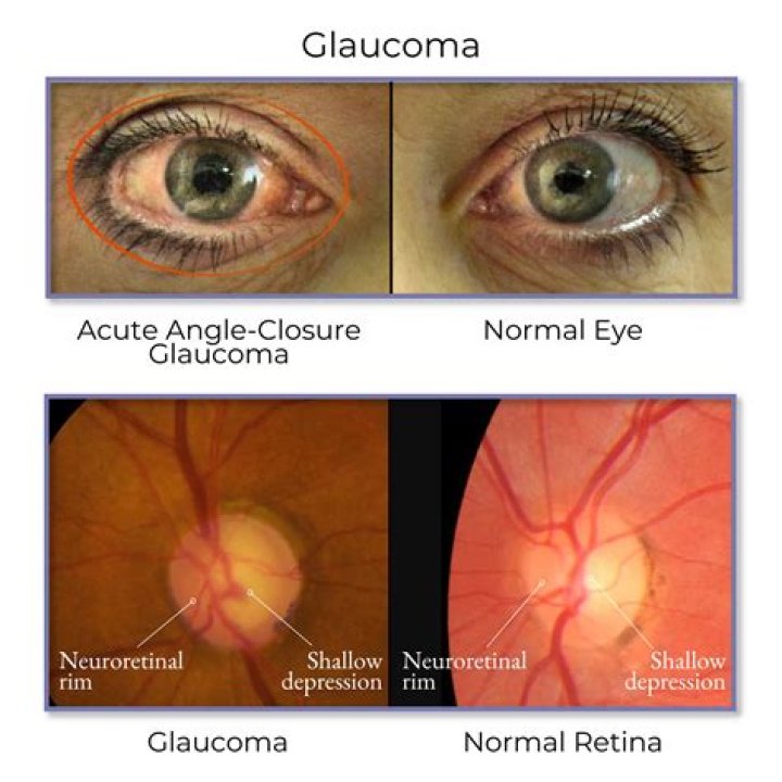 What is bilateral glaucoma suspect?