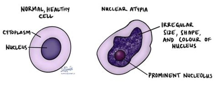 What is Hyperchromatic pleomorphic nuclei?