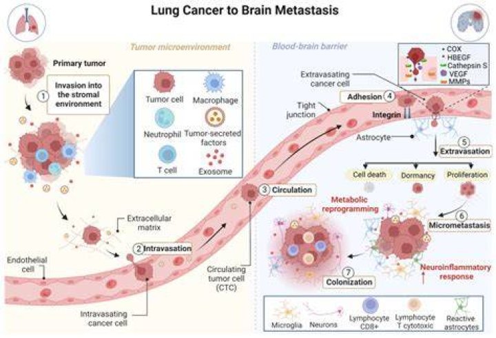 What is metastasis to the lungs?