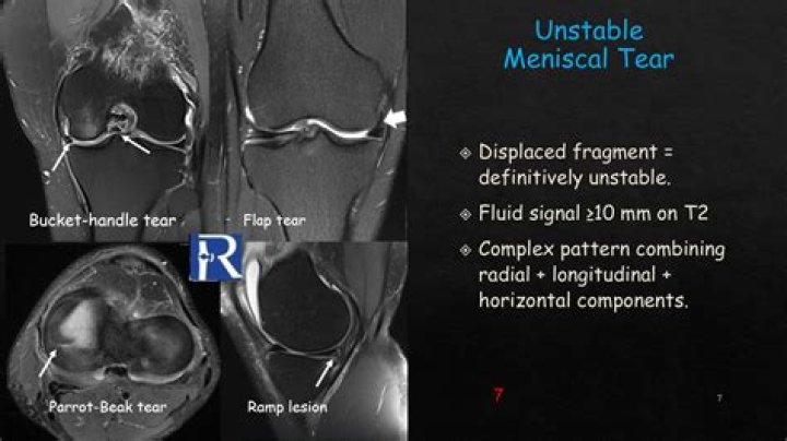 What is MRI for pec tear?