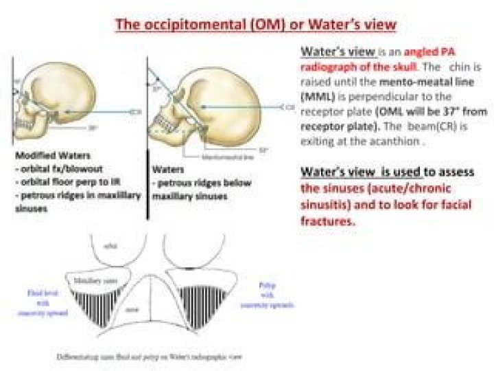 What is Occipitomental view?