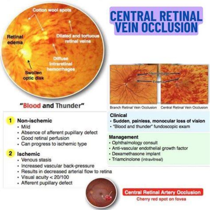 What is the blood and thunder retina?