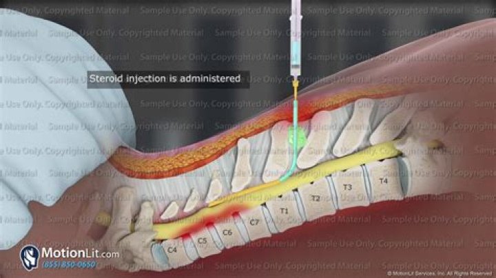 What should I watch after epidural steroid injection?