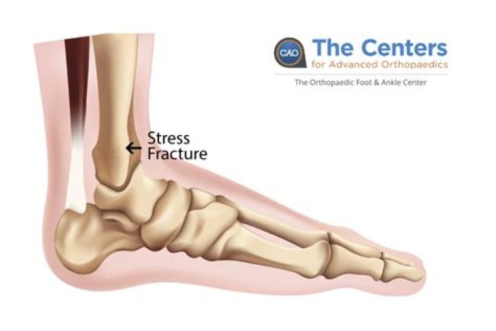 Why does my stress fracture keep coming back?
